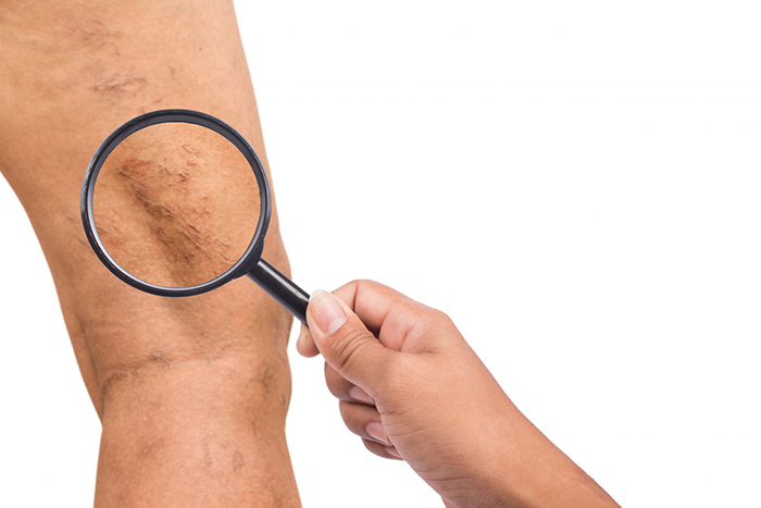 Laser Vascular Treatment