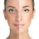 The Benefits of Laser Skin Treatment