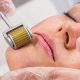 Is the Act of Micro-Needling Truly Effective?